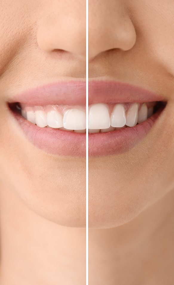 Gum recontouring can make your smile appear larger