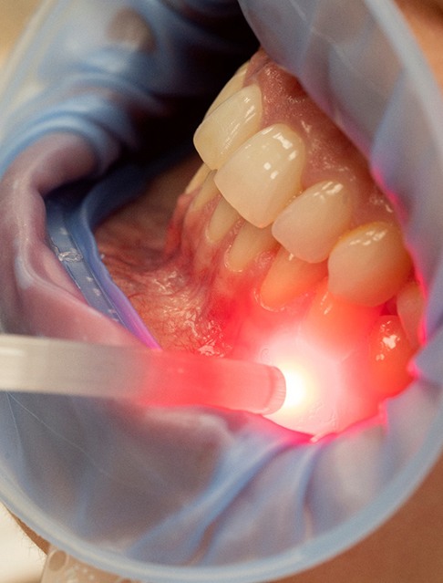 Gum recontouring is a treatment to reshape or remove excess gum tissue