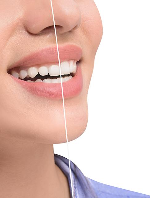 Patients with excess gum tissue may be a good candidate for gum recontouring