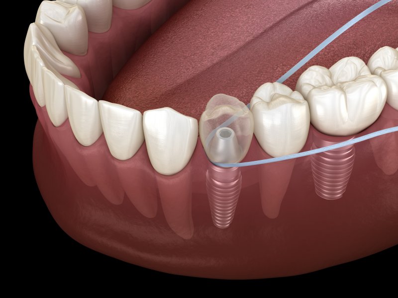 Digital illustration of flossing a dental implant